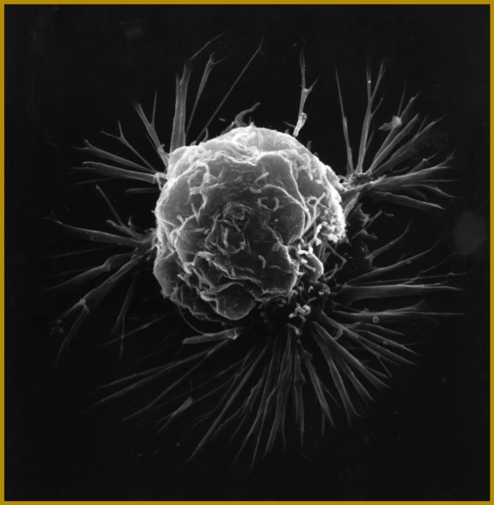 AI Model Predicts Cancer Survival from Facial Photos, Researchers Say