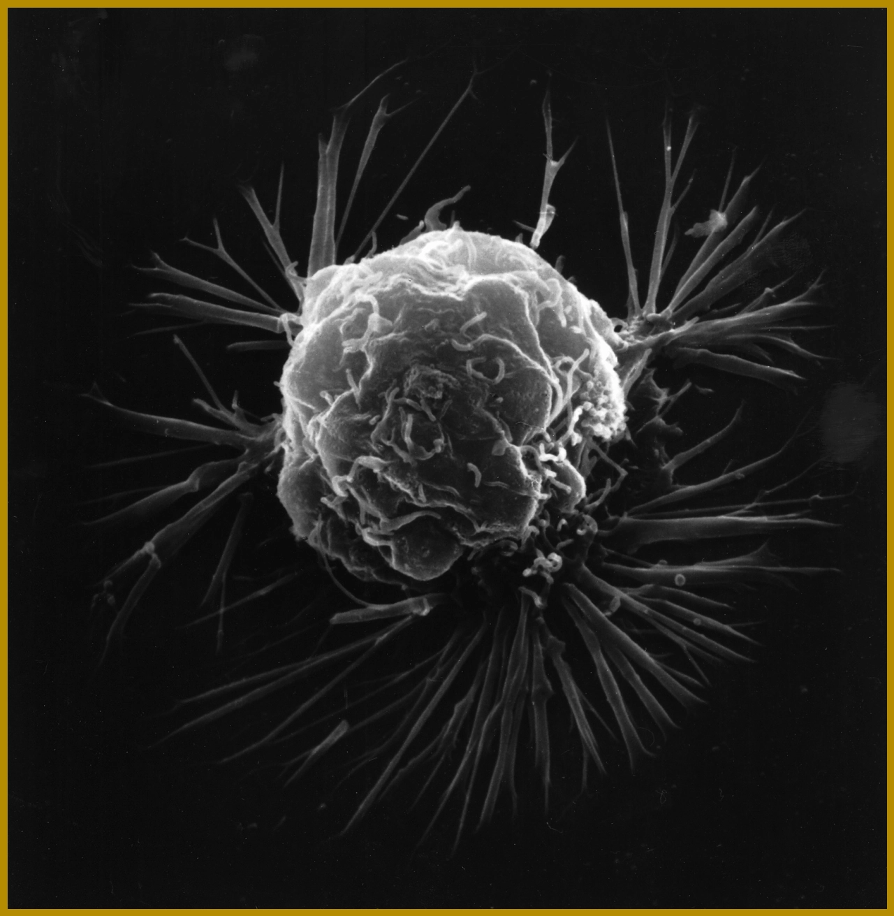 Breast cancer cell (2)